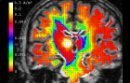 To achieve a deeper understanding of the brain, scientists and clinicians use Electroencephalography (EEG) and Magnetoencephalography (MEG) inverse methods to reconstruct sources in the cortical sheet of the human brain. The influence of structural and electrical anisotropy ...