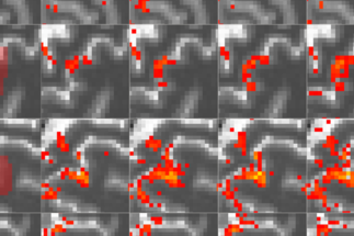 Image detail: Activation maps acquired with and without an MT-pulse 