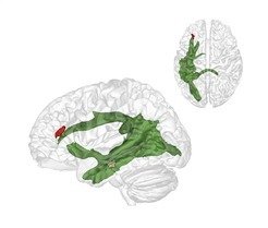 <p>Als eine Art Datenautobahn verknüpft der Fasciculus Arcuatus (grün) ab etwa dem vierten Lebensjahr zwei wesentliche Hirnareale miteinander: Eine Region im hinteren Schläfenlappen (braun), die uns im Erwachsenenalter hilft, über andere Menschen und deren Gedanken nachzudenken, und ein Areal im Frontallappen im vorderen Großhirn (rot), das uns vermutlich dabei hilft die Gedanken anderer und die wirkliche Welt auf anderen Abstraktionsebenen zu halten. <span style="font-family: Times New Roman,Times,serif;"><span style="font-family: Times New Roman,Times,serif;"><span style="font-family: Times New Roman,Times,serif;">© Nature Communication<br /></span></span></span></p>
