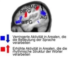 Sind die Areale, die eigentlich für die Verarbeitung der Wortbedeutung zuständig sind (blau; AG= Gyrus angularis, aIFG= anteriorer Gyrus frontalis inferior), entweder durch einen Schlaganfall oder künstlich mithilfe der transkraniellen Magnetstimulation in ihrer Arbeit gestört, übernehmen die Areale für die Lautverarbeitung (rot; SMG= Gyrus supramarginalis, pIFG= posteriorer Gyrus frontalis inferior) ihre Funktion. <span class="st">©</span> geändert nach elife