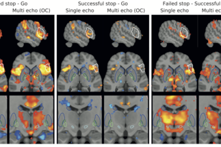fMRI of the Basal Ganglia at 7T using single- and multi-echo protocols