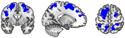 There was less brain response in the regions that are involved in performing that type of motor learning task.