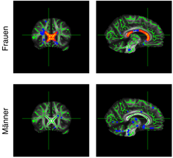 Bei übergewichtigen Frauen traten im Corpus callosum größere Veränderungen (rot markiert) auf als bei den männlichen Testpersonen.