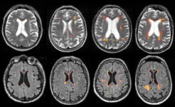 So-called white matter lesions are indications of tiny vascular damage in the brain and can be measured in an MRI scan.