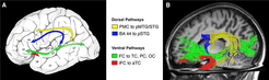 Das menschliche Sprachnetzwerk. Broca-Areal (Areal 44 und 45), Wernicke-Areal (Areal 22). Pfeile (links) symbolisieren die neuroanatomischen Faserverbindungen (rechts) zwischen den sprachrelevanten Hirnarealen.