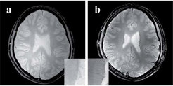 Anatomische Bildgebung: direkter Vergleich zwischen einer Hochfeld- und einer Ultra-Hochfeldaufnahme. a) Bei 3 Tesla reicht das Signal-zu-Rausch-Verhältnis nicht aus, um kleinere Gefäße zu erfassen, erkennbar im vergrößerten Ausschnitt (a, unten).b) Dieselbe Akquisition bei 7 Tesla zeigt ein erheblich verbessertes Signal-zu-Rausch-Verhältnis. In der Vergrößerung (b, unten) sind auch kleinere Gefäße gut aufgelöst.