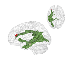 The maturation of fibres of a brain structure called the arcuate fascicle (green) between the ages of three and four years establishes a connection between two critical brain regions: A region at the back of the temporal lobe (brown) that supports adults thinking about others and their thoughts and a region in the frontal lobe (red) that is involved in keeping things at different levels of abstraction and, therefore, helps us to understand what the real world is and what the thoughts of others are. © Nature Communication