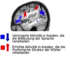 Sind die Areale, die eigentlich für die Verarbeitung der Wortbedeutung zuständig sind (blau; AG= Gyrus angularis, aIFG= anteriorer Gyrus frontalis inferior), entweder durch einen Schlaganfall oder künstlich mithilfe der transkraniellen Magnetstimulation in ihrer Arbeit gestört, übernehmen die Areale für die Lautverarbeitung (rot; SMG= Gyrus supramarginalis, pIFG= posteriorer Gyrus frontalis inferior) ihre Funktion. © geändert nach elife