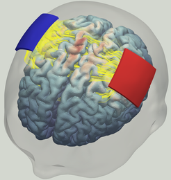 3D head model with a dual electrode setup. The electrical field strength is visualized on the brain surface using a heatmap. The current flow between the electrodes is represented by streamlines.