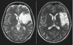 Abbildung 2: Mithilfe der Magnetresonanztomografie wurde für jeden Patienten der genaue Ort der Schädigung bestimmt. Deutlich zu sehen ist auf beiden Scans eine Läsion in der linken Hirnhälfte (hier in der radiologischen Ansicht seitenverkehrt). Nur bei dem Patienten auf der linken Seite sind zusätzlich die tieferliegenden Basalganglien betroffen.