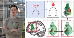 Neuroanatomical model of the Merge mechanism. (A) Two linguistic objects (α and β) are combined together to form a labeled linguistic structure (γ). (B) Phrasal construction resulting from the combination of a determiner with a pseudonoun („this flirk“) leads to functional activation (C) in Brodmann Area 44, more specifically, in its anterior-ventral Cluster C3 (Clos et al. 2013). (E) shows individual peak localization in BA44 with clustering in the C3 region. © Adapted from Zaccarella & Friederici, 2017, Neurosci Biobehav Rev.