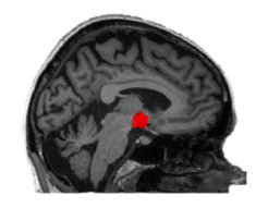 MRI of the brain with a red area in the center.