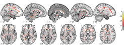 Several brain scans with activation areas in red, shown in different sagittal and axial planes.