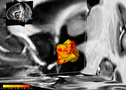 Blick von der linken Schläfe aus auf den linken Hypothalamus im Zentrum des Gehirns: Bei Personen mit Depressionen und bipolarer Störung sind einige Regionen des Hypothalamus vergrößert (rot), einige sind jedoch auch verkleinert (gelb). © Acta Psychiatrica Scandinavica